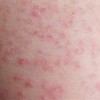 色素性荨麻疹的症状有哪些呢