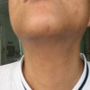什么叫做职业性黑变病