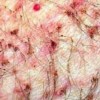 男性阴虱病怎么治疗