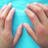 局限性硬皮病预后效果好吗