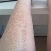 毛囊性鱼鳞病的发病的原因及治疗的方法
