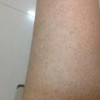 针对毛囊性鱼鳞病症状为大家做的介绍