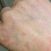 为大家讲讲过敏性皮炎是什么症状