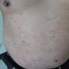 副银屑病应该怎样止痒呢