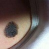 恶性黑色素瘤的肢端雀斑样痣型表现特征