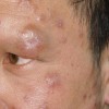 麻风是怎么进行传染的