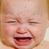 小儿过敏性紫癜的临床症状