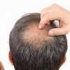 脂溢性脱发的病因和症状是什么呢