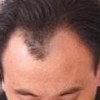 脂溢性脱发的危害具体都有些什么
