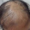 如何治疗脂溢性脱发