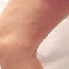 静脉曲张综合征的预防保健措施