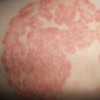 女性患乳房湿疹的原因