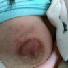 女性乳房湿疹注意什么