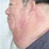 肝上的脂肪瘤应怎样调养