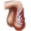 股癣与阴囊湿疹的区别是什么
