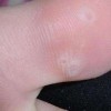 脚上长鸡眼什么样子呢