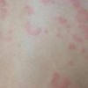 寒冷性荨麻疹症状是由什么引起的