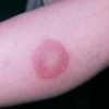 传染性红斑有什么预防措施