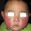 治疗传染性红斑有哪些方法可以用