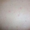 接触性荨麻疹该如何的诊断呢