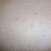 热接触性荨麻疹的症状介绍