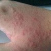 触摸性荨麻疹一般有什么表现
