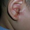 耳湿疹的病因有什么呢