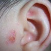 详细的耳湿疹治疗方法