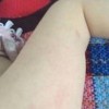 荨麻疹型药疹的特点有什么