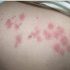 单纯痒疹有何症状表现呢
