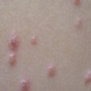单纯痒疹的发病症状是什么