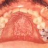 口腔念珠菌病要与哪些疾病区分呢