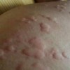 春季急性荨麻疹的常见患病原因有什么呢