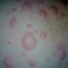 急性荨麻疹的症状表现
