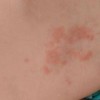 急性荨麻疹会传染吗