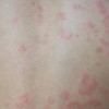 急性荨麻疹的症状有什么特点