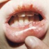 口腔白斑的主要症状有哪些呢