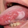 口腔白斑属于癌前病变是什么