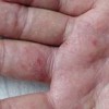 生活中怎样预防外阴湿疹发生呢