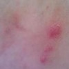 外阴湿疹瘙痒的原因有哪些呢