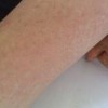 夏季如何预防女性外阴湿疹