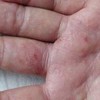 导致外阴湿疹瘙痒原因都有哪些呢