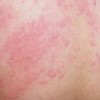 诱发冬季皮肤瘙痒症的因素很多