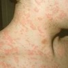 冬季瘙痒症的皮损症状是什么
