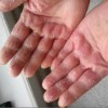 手部皲裂性湿疹在治疗时应该注意什么