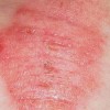 亚急性湿疹的临床特点是什么