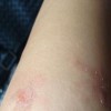 丘疹性荨麻疹有痛痒感吗