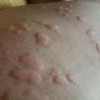 丘疹性荨麻疹的发病征兆