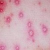 一期梅毒发病有什么明显的症兆