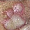 女性一期梅毒有哪些症状特点